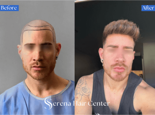 Crown Area Restoration with Minimal Scarring