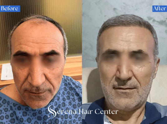 Older man hair transplant before and after, hair loss treatment, hair restoration, natural-looking results