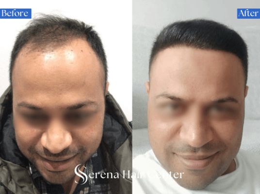 Thinning hair hair transplant before and after, hair loss treatment, hair restoration, hair density
