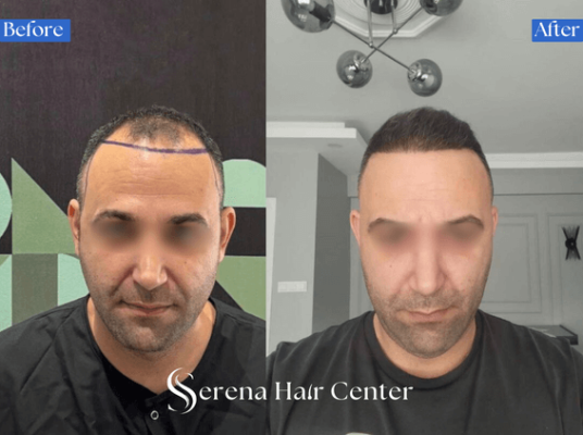 Receding hairline hair transplant before and after, hair loss solution, hair restoration, hairline restoration