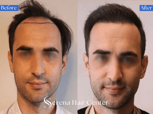 Hairline Restoration Using Needle-Free Anesthesia
