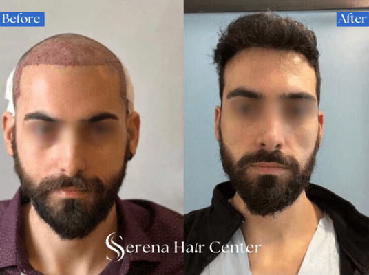 Before and after hair transplant, baldness to full head of hair, hair restoration, hair transplant surgery