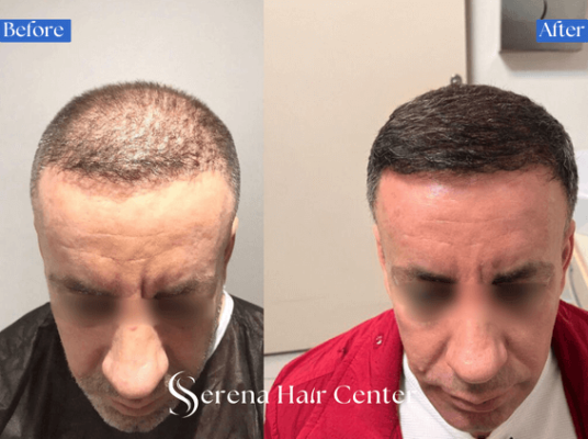 Beard and Hairline Enhancement Transplant Results