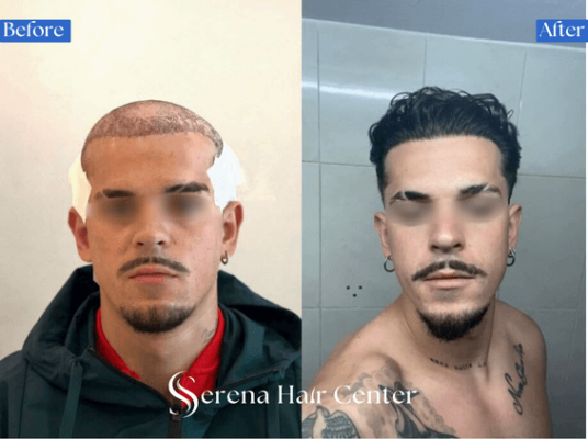 Full Hair Restoration Journey with Turkish Experts