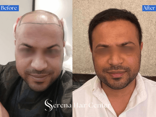 Sapphire FUE Hair Transplant Results for Receding Hairline