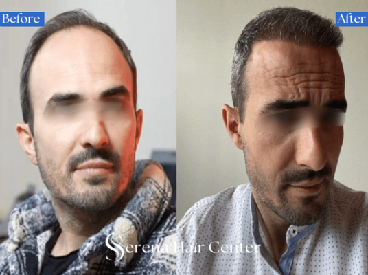 Advanced DHI Hair Restoration Results in Turkey