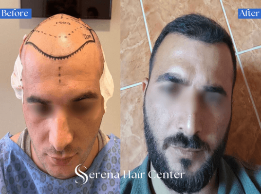 FUE Hair Transplant Before and After by Serena Hair Center