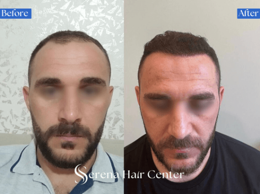older man hair transplant before and after, hair loss treatment, hair restoration, natural-looking results