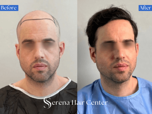 young man hair transplant before after, hair loss treatment, hair restoration, youthful appearance