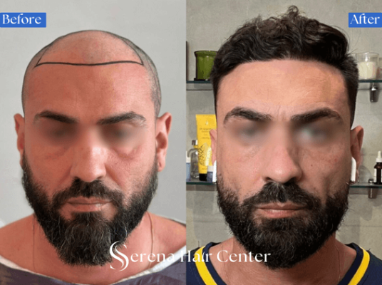 hair transplant before after, hair loss solution, hair restoration, dramatic transformation