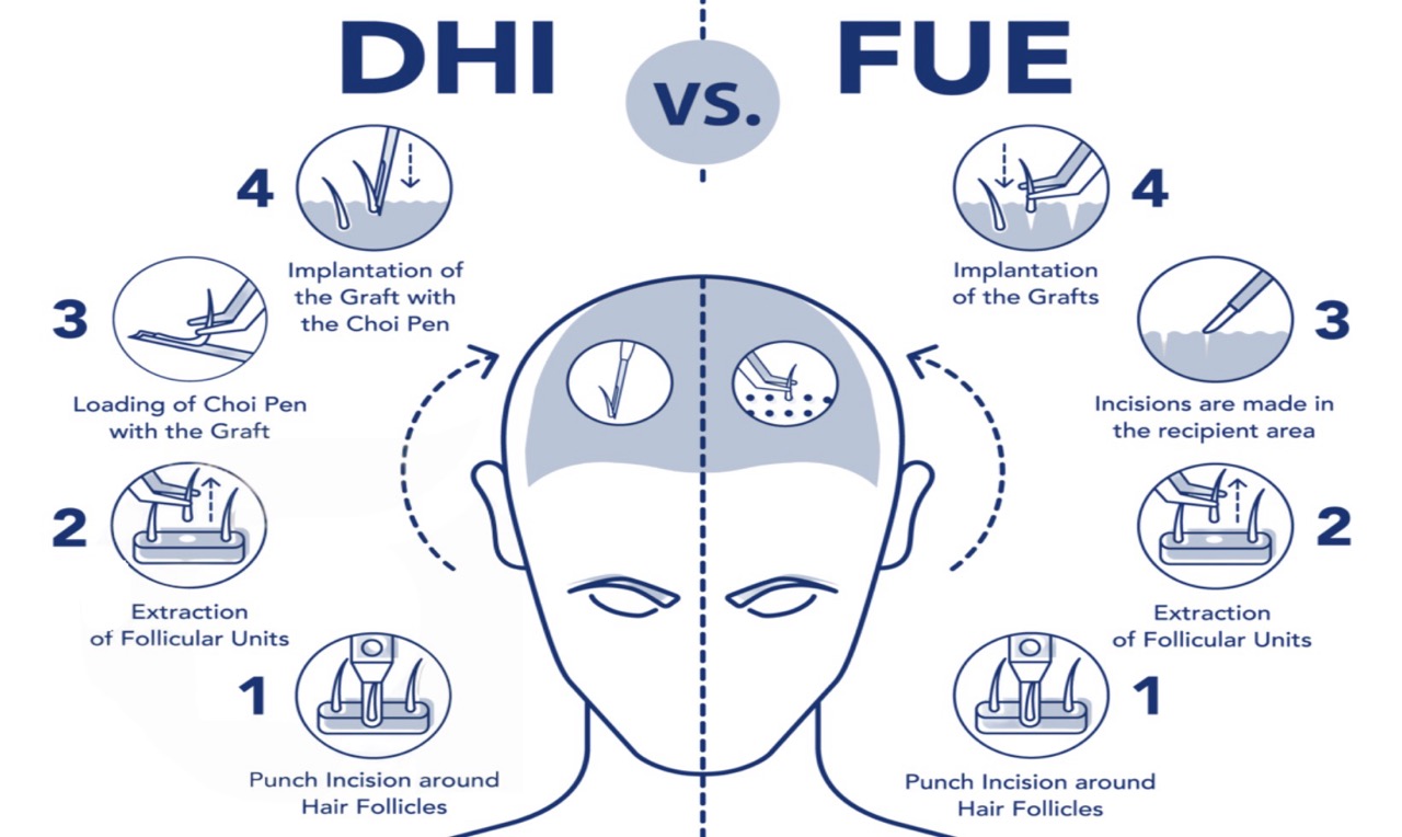 FUE vs DHI Hair Transplant in Turkey