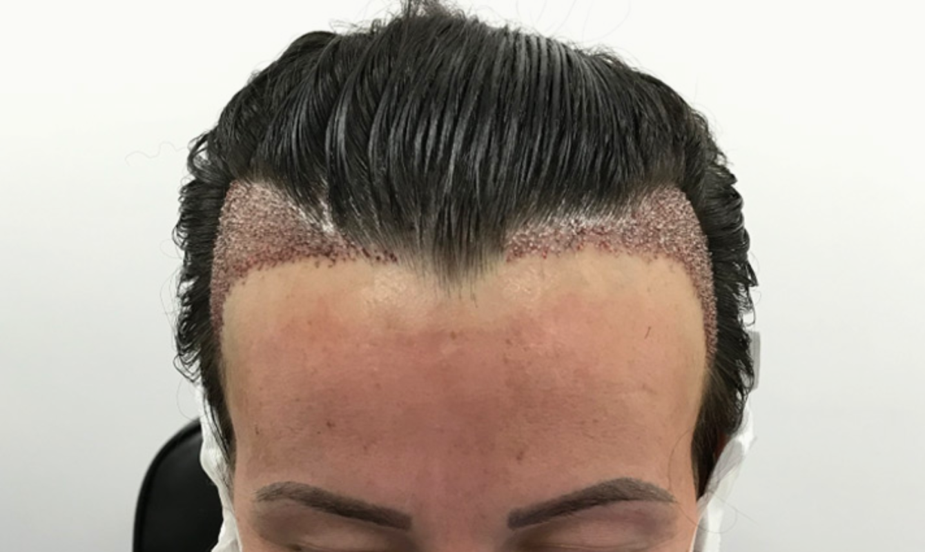 Female Hair Transplant Techniques and Success Rates