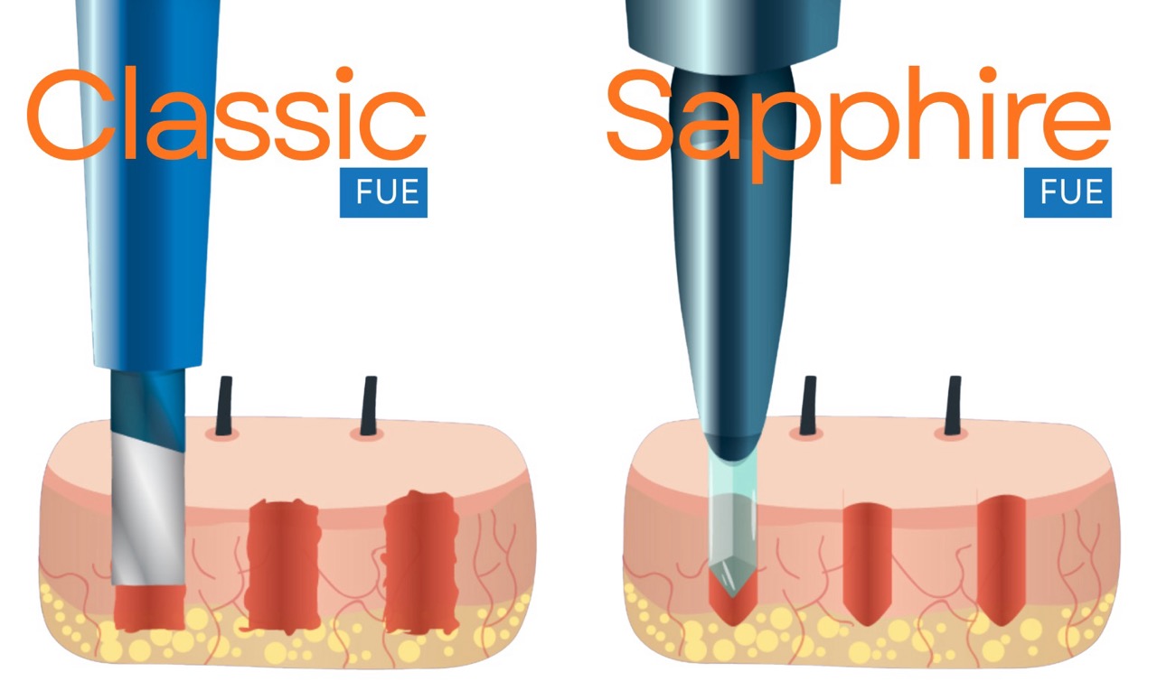 fue vs sapphire fue hair transplant