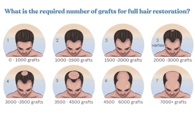 What is the required number of grafts for full hair restoration?