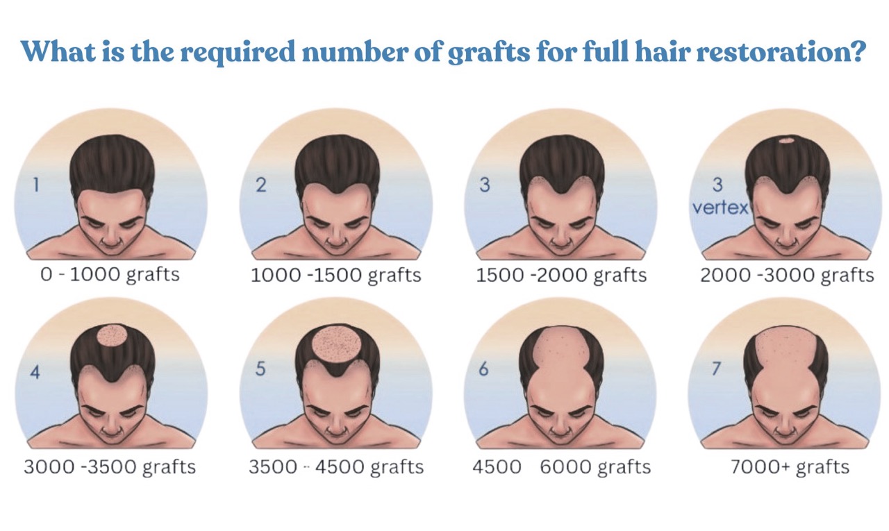 What is the required number of grafts for full hair restoration?