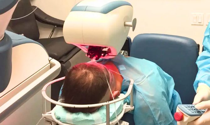 A robotic hair transplant uses computerized systems and robotic arms to assist surgeons during extraction and planning steps
