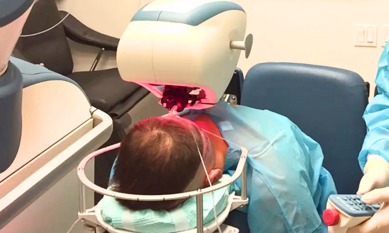 A robotic hair transplant uses computerized systems and robotic arms to assist surgeons during extraction and planning steps