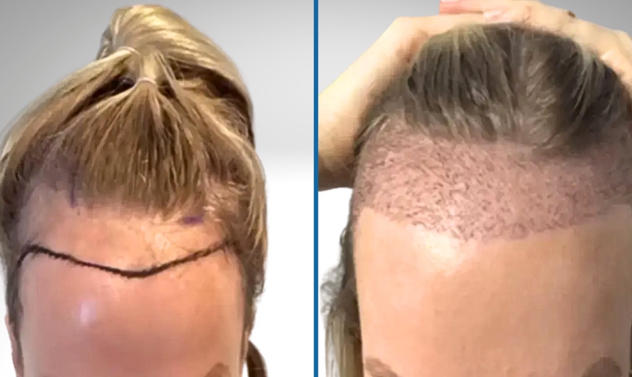 successful female hair transplant results before and after