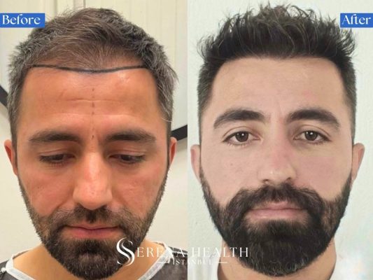 Before and after transformation of a 3000 grafts hair transplant focused entirely on the frontal third.