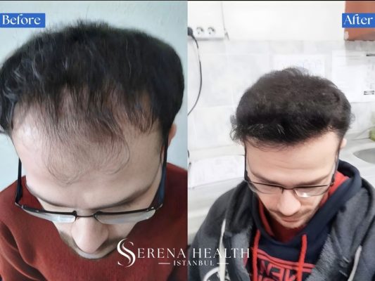 Before and after progress showcase at 9 months post-op showing highly developed hair density.