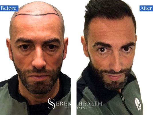 Before and after results of an FUE hair transplant on a patient with coarse, thick hair texture.