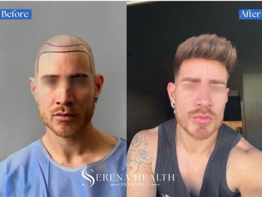 Front view before and after comparison of a male patient who underwent a DHI hair transplant for a receding hairline.
