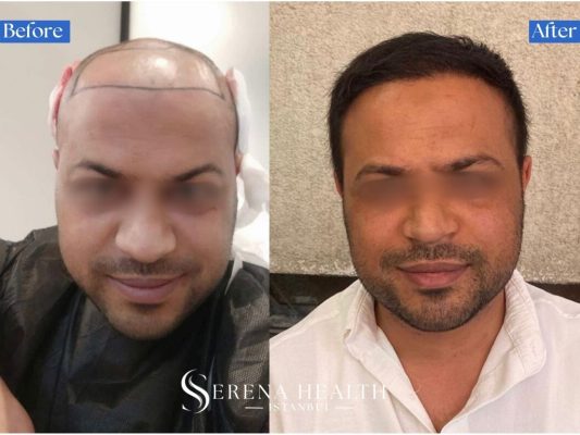 Before and after comparison of a hair transplant enhanced with exosome therapy for accelerated healing and density.