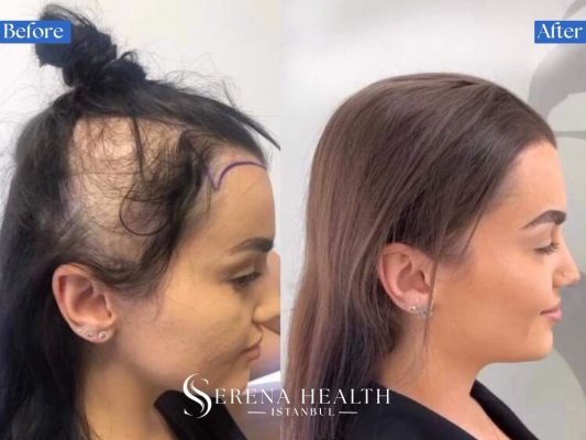 Before and after photos of a female hair transplant correcting a high forehead and traction alopecia.