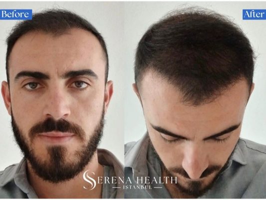 Before and after results of a combined FUE and DHI hair transplant technique performed in one session.