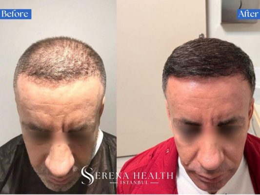 Top view before and after results of an FUE hair transplant showing full coverage of a bald crown and vertex area.