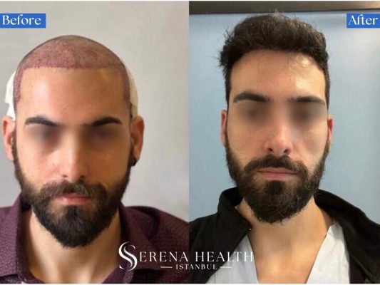 Before and after images showing successful correction of severe mid-scalp and central hair thinning.