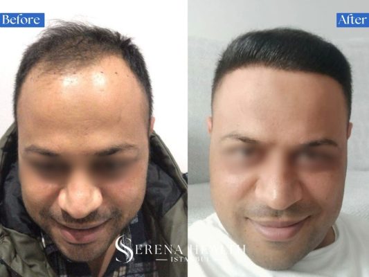 Macro close-up before and after photo showing the natural 45-degree angle of a transplanted hairline.
