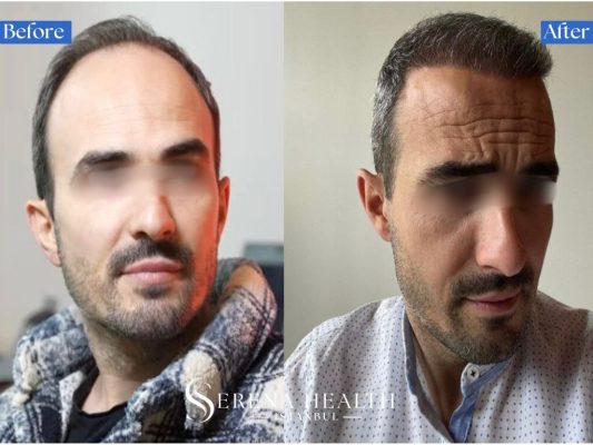 Before and after transformation of a Norwood Scale 4 baldness pattern treated with a high-graft hair transplant.