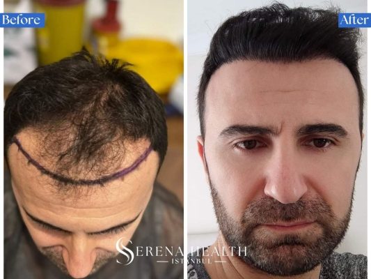 Extensive before and after transformation of a Norwood Scale 5 baldness case across multiple zones.