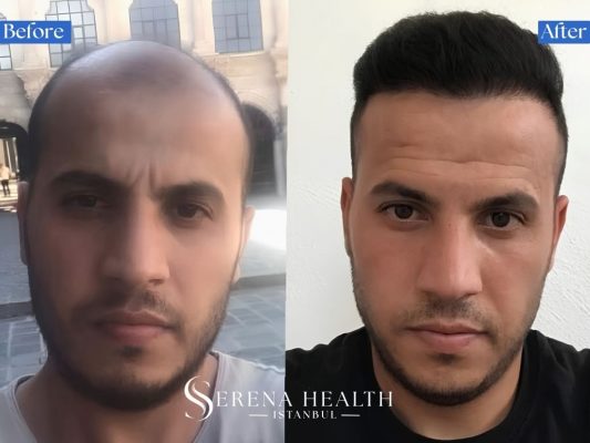 Before and after photos showing rapid scalp healing assisted by post-op red-light therapy sessions.