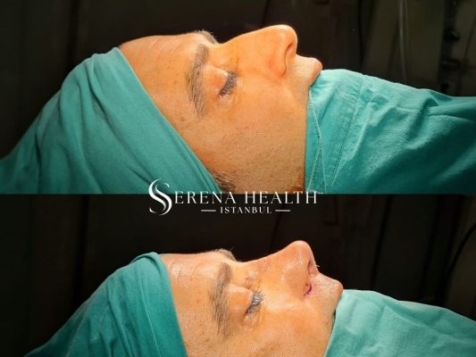 Bottom basal view comparison before and after rhinoplasty showing the narrowing of a bulbous nose tip and wide nostrils.