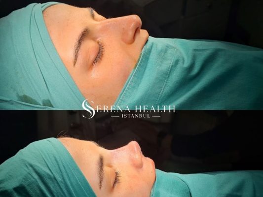 Front view comparison before and after rhinoplasty to correct a deviated septum and crooked nasal bridge.