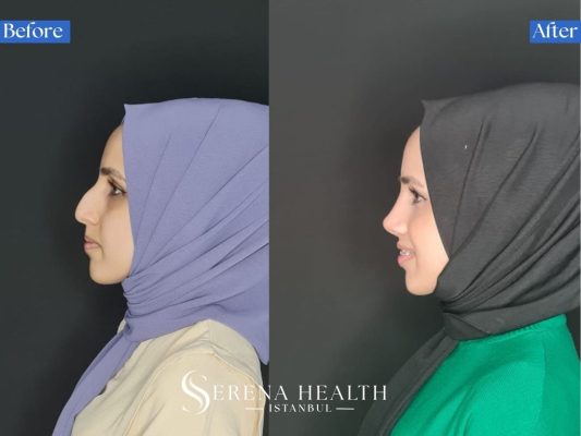 Side profile view before and after rhinoplasty surgery showing the smooth removal of a severe nasal dorsal hump.