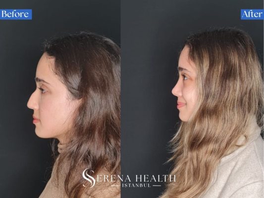 Three-quarter oblique view before and after rhinoplasty showing a nasal tip lift to correct a drooping nose.