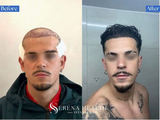 Side profile before and after photos of a patient's temple recession restored using a Sapphire FUE hair transplant.