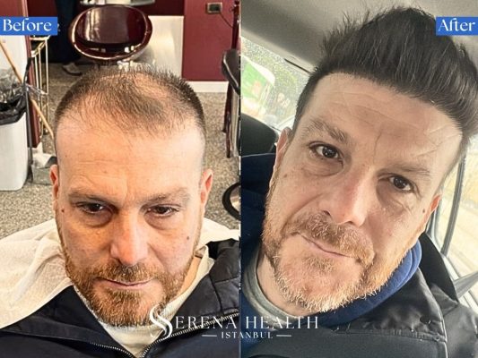 Before and after photos of a sharp, modern straight hairline design achieved via FUE hair transplant.