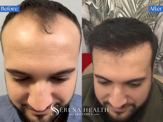 Before and after close-up of reconstructed temporal points and lateral recession angles via hair transplant.