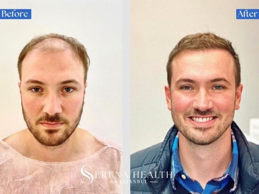 Full head before and after total transformation from severe baldness to complete hair restoration.