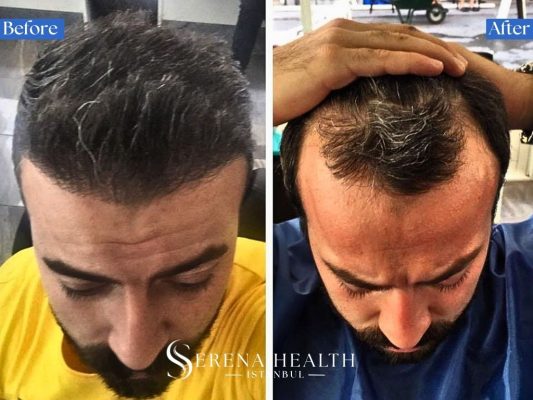 Before and after results of an unshaven DHI hair transplant where the existing hair was kept long during surgery.