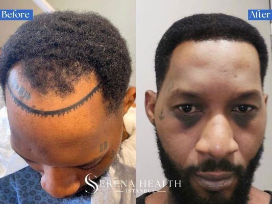 Before and after results of a conservative hair transplant for an early-stage young male patient.