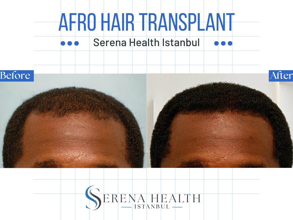 Afro-textured hair patient demonstrating excellent healing and hair growth post-transplant.