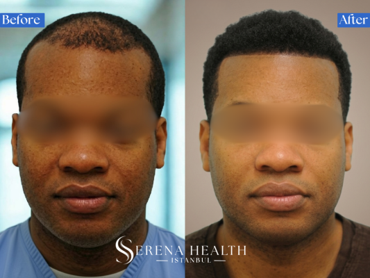 Patient results showing temple hairline refinement using specialized afro hair graft techniques.