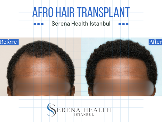 Patient profile view showing a refined and natural afro-textured hairline restoration result.