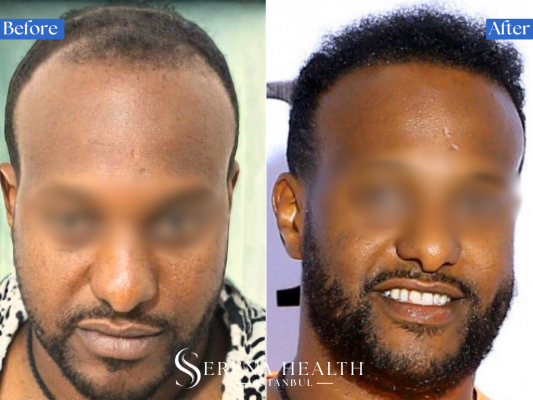 Male patient after afro hair transplant showing a natural restored hairline in Istanbul.