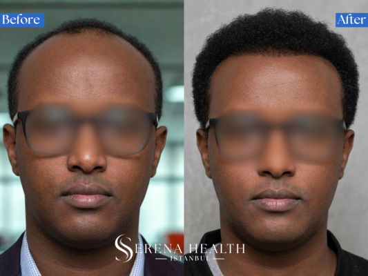 Before and after of afro hair transplant focusing on mid-scalp density improvement.